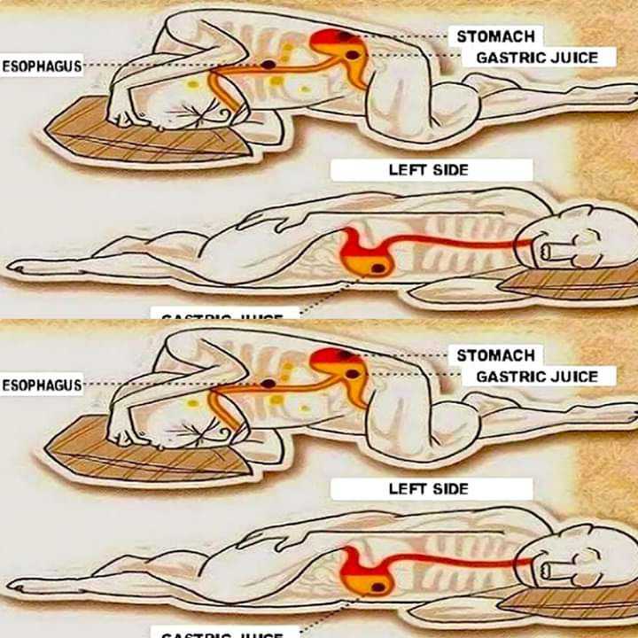 Best Sleeping Position for Acid Reflux and Heartburn